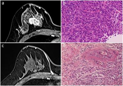Pre-operative MRI in evaluating pathologic complete response to neoadjuvant chemotherapy in patients with breast cancer: a study focused on influencing factors of baseline clinical-pathological and imaging features